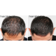 HairMax LaserBand 82 - ComfortFlex laserkamm-vöö (16970)