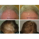 HairMax LaserCap 272 PowerFlex - lasermüts (LASER 272)