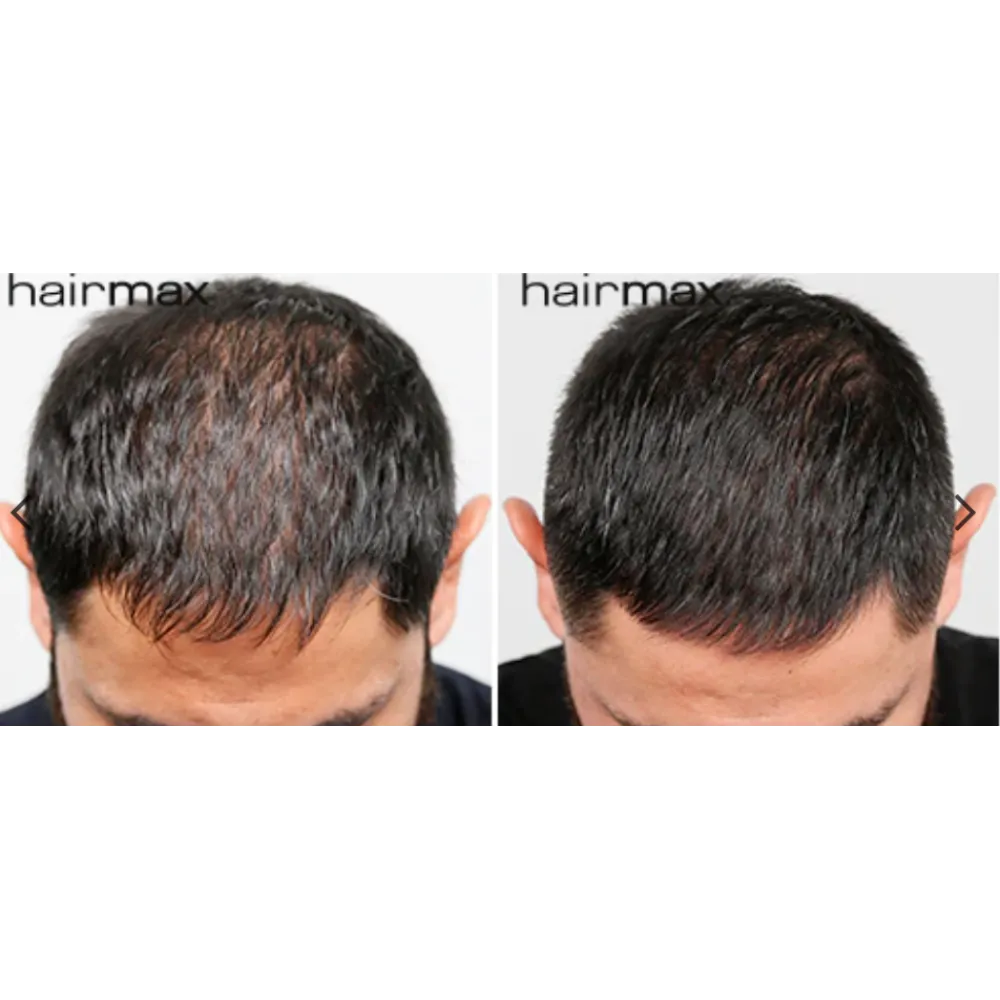 HairMax LaserBand 82 – ComfortFlex laserkammrihm, lilla