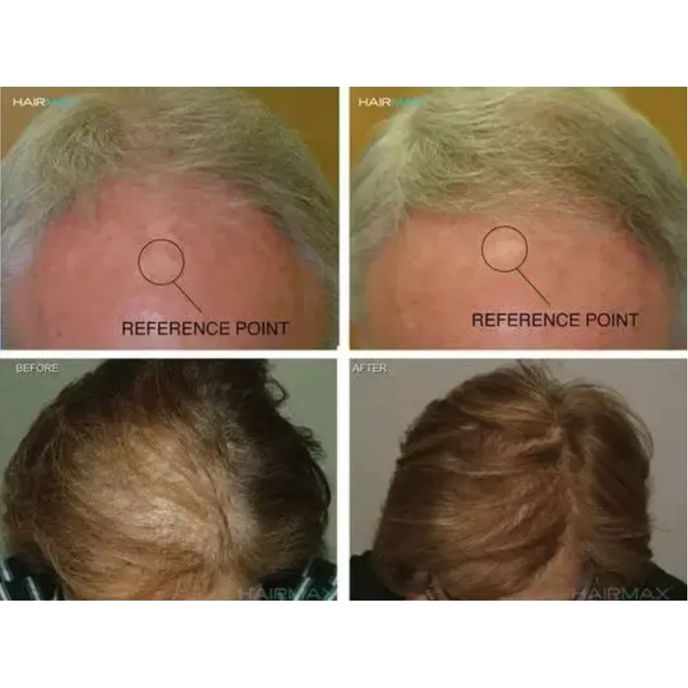 HairMax LaserCap 272 PowerFlex - lasermüts