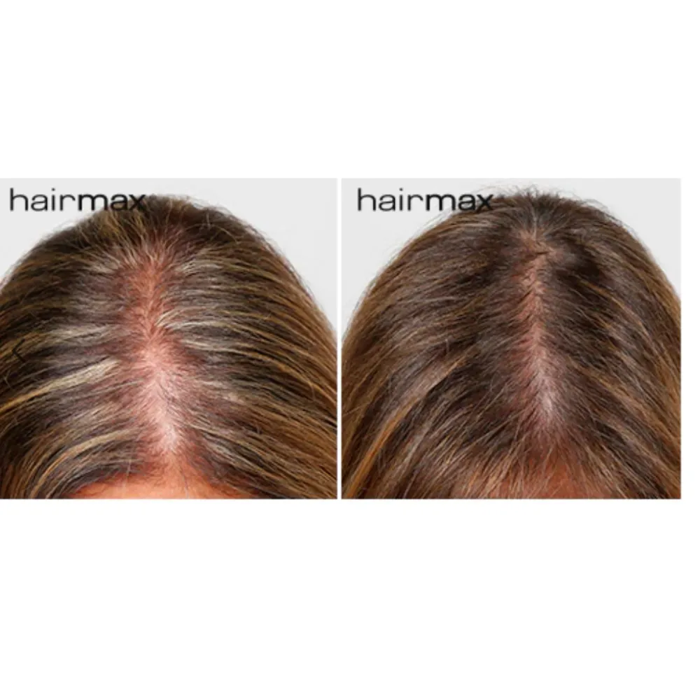 HairMax LaserBand 82 – ComfortFlex laserkammrihm, lilla